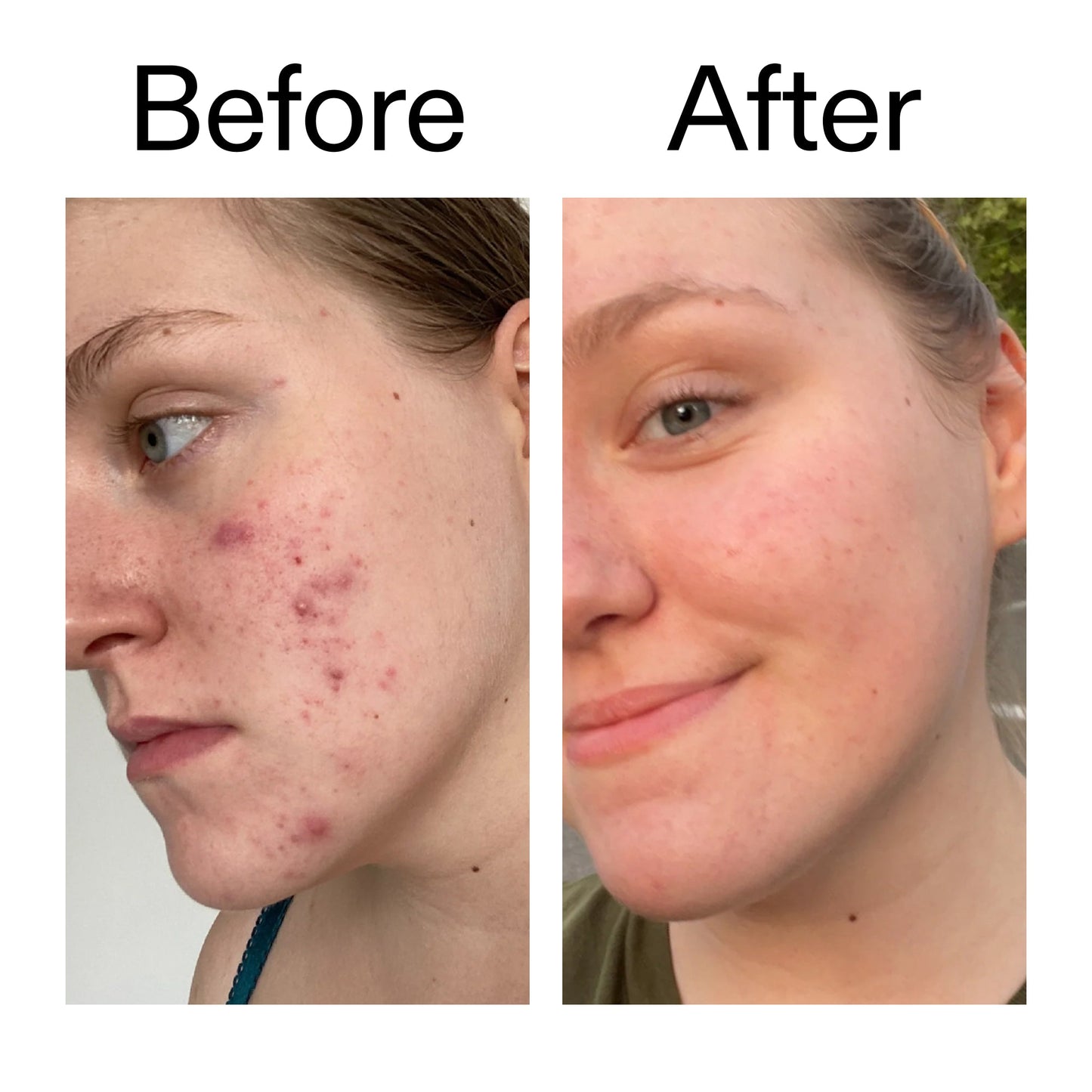 15-vitamin-c-egf-serum-e0 15_Vitamin_C_EGF_Serum_Before_After_2000x2000_fb9f598a-3386-40c8-8143-36f9d7a17ec8.jpg