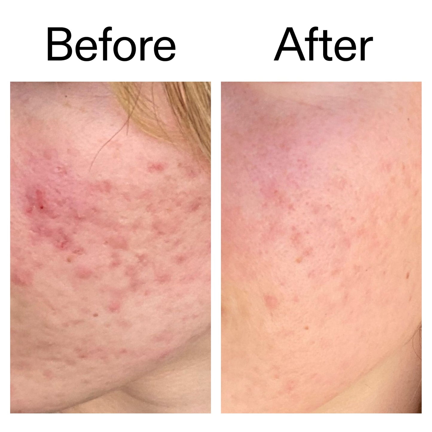 10-azelaic-acid-serum-for-redness-relief-e6 Azealic_Acid_Serum_B_A_Ppage_2000_x_2000.jpg