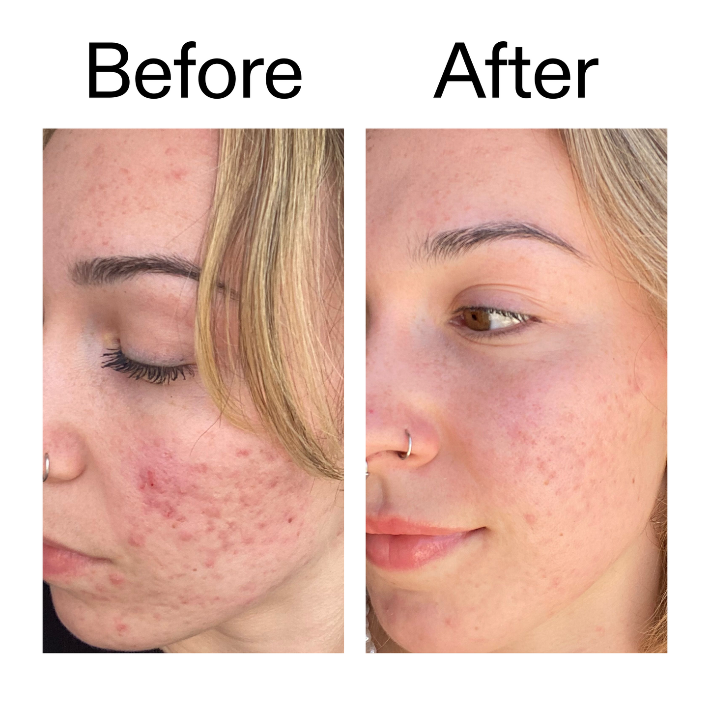 10-azelaic-acid-serum-for-redness-relief-e6 B_A_2_PPAGE.png