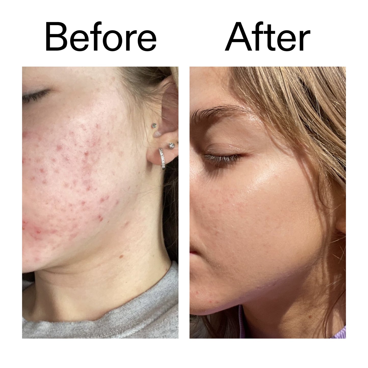 beta-hydroxy-acid-bha-serum-p5 Beta_Hydroxy_Acid_Serum_Before_After_2000x2000_96fda3e5-938d-49ef-bcf2-a0fa6ece4e2c.jpg