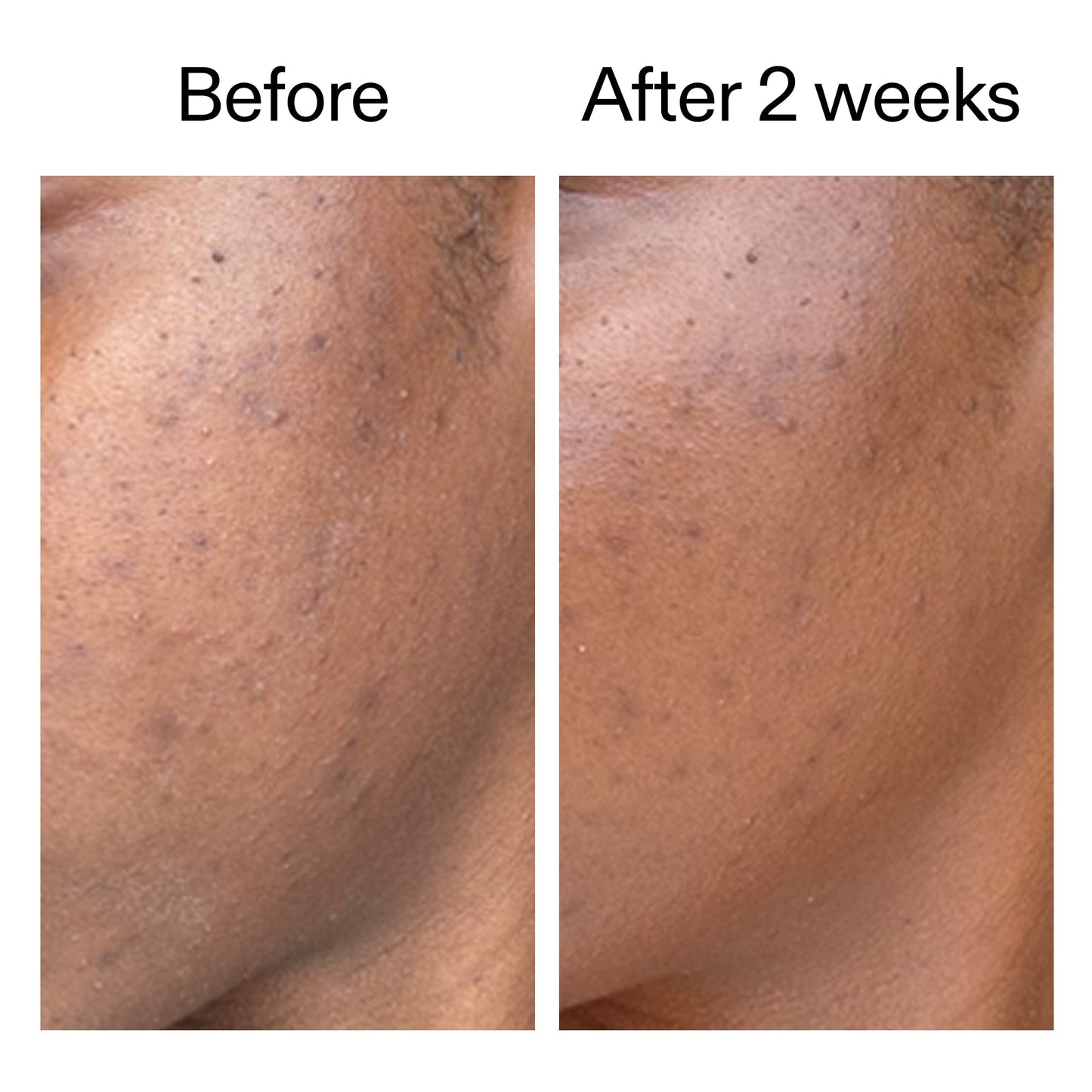 360-acne-clearing-duo-f2 DIOICB_A2000x2000.jpg