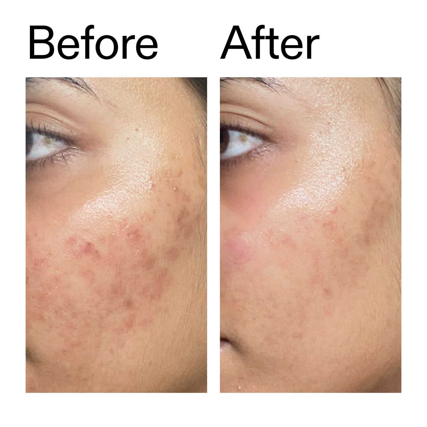 ectoin-hydro-barrier-serum-i9 Ectoin_Hydro-barrier_Serum__Before_After_2000x2000_34261920-d004-48d0-9c7b-8e1c15971bfd.jpg