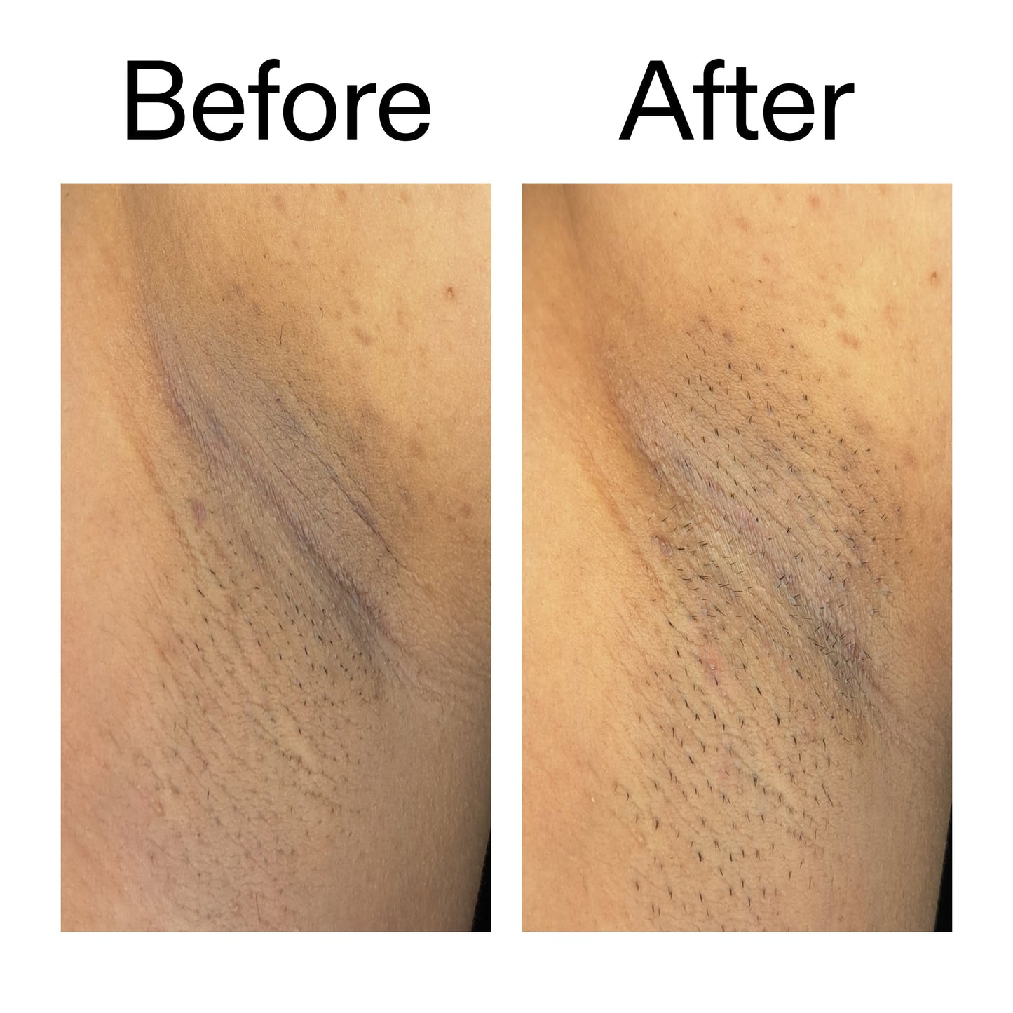 glycolic-acid-exfoliating-body-stick-duo-q8 Glycolic_Acid_Exfoliating_Body_Stick_Before_After_V3_2000x2000_ea919cd9-1439-4a46-82a0-76200eb5bb42.jpg
