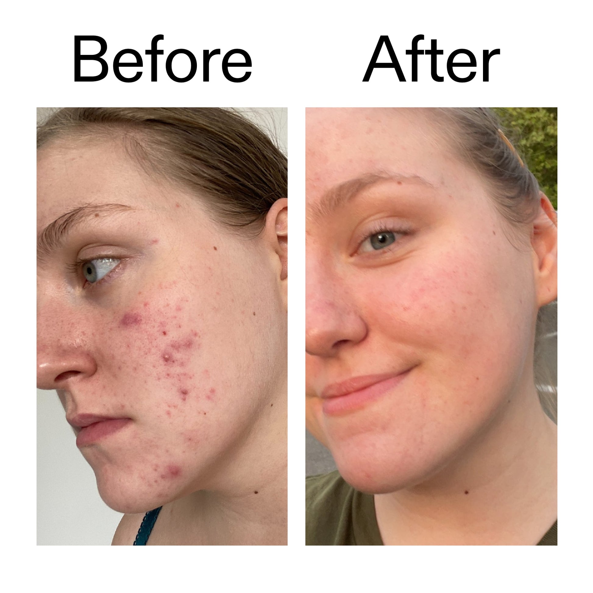 glycolic-acid-toner-c4 Glycolic_Acid_Toner_Before_After_2000x2000_49f0b9f7-e71b-4b2e-a8f8-2ea4b73247bb.jpg