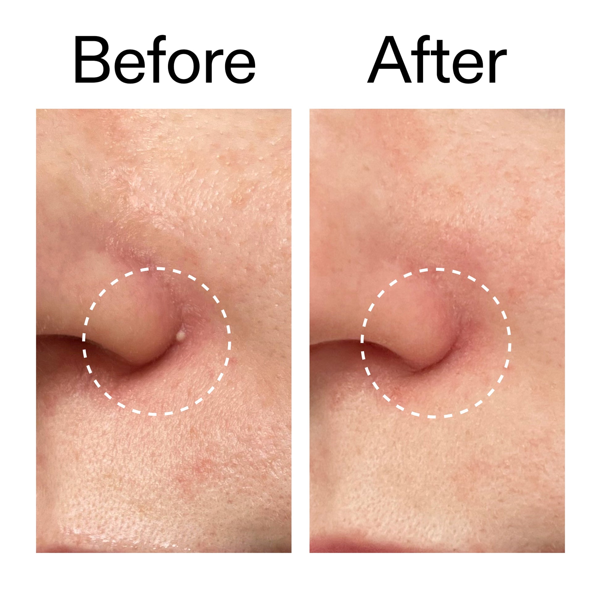hydrocolloid-invisible-pimple-patches-pack-of-22-s3 Hydrocolloid_Invisible_Pimple_Patches_Before_After_2000x2000_b02aa37b-c78a-4682-91de-9135af5bb7df.jpg