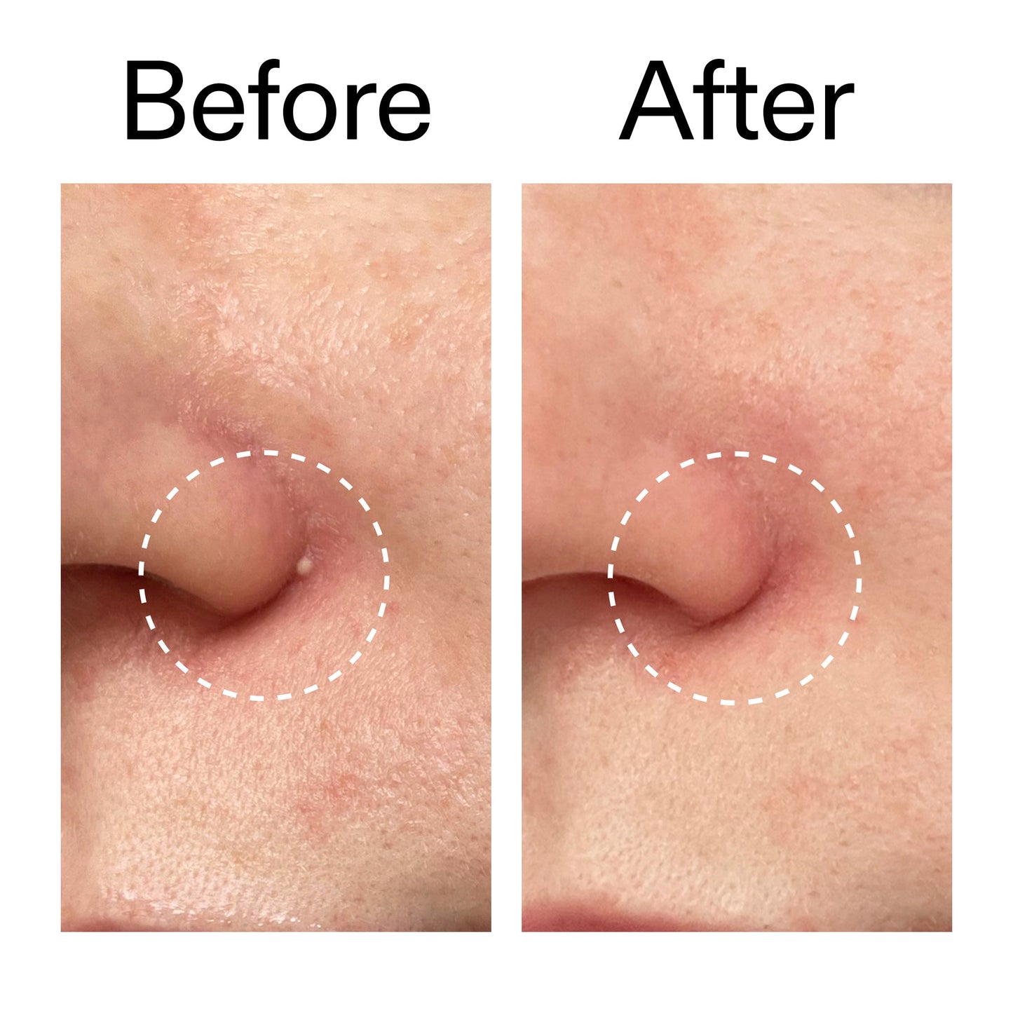 hydrocolloid-invisible-pimple-patches-pack-of-44-s4 Hydrocolloid_Invisible_Pimple_Patches_Before_After_2000x2000_b02aa37b-c78a-4682-91de-9135af5bb7df.jpg