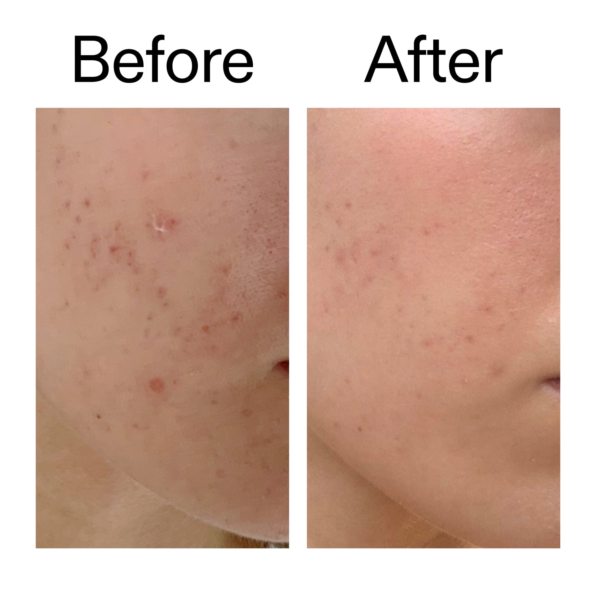 mandelic-acid-treatment-h9 Mandelic_Acid_Treatment_Before_After_2000x2000_4885ac6e-c5d7-4279-a72a-1417af7dce35.jpg