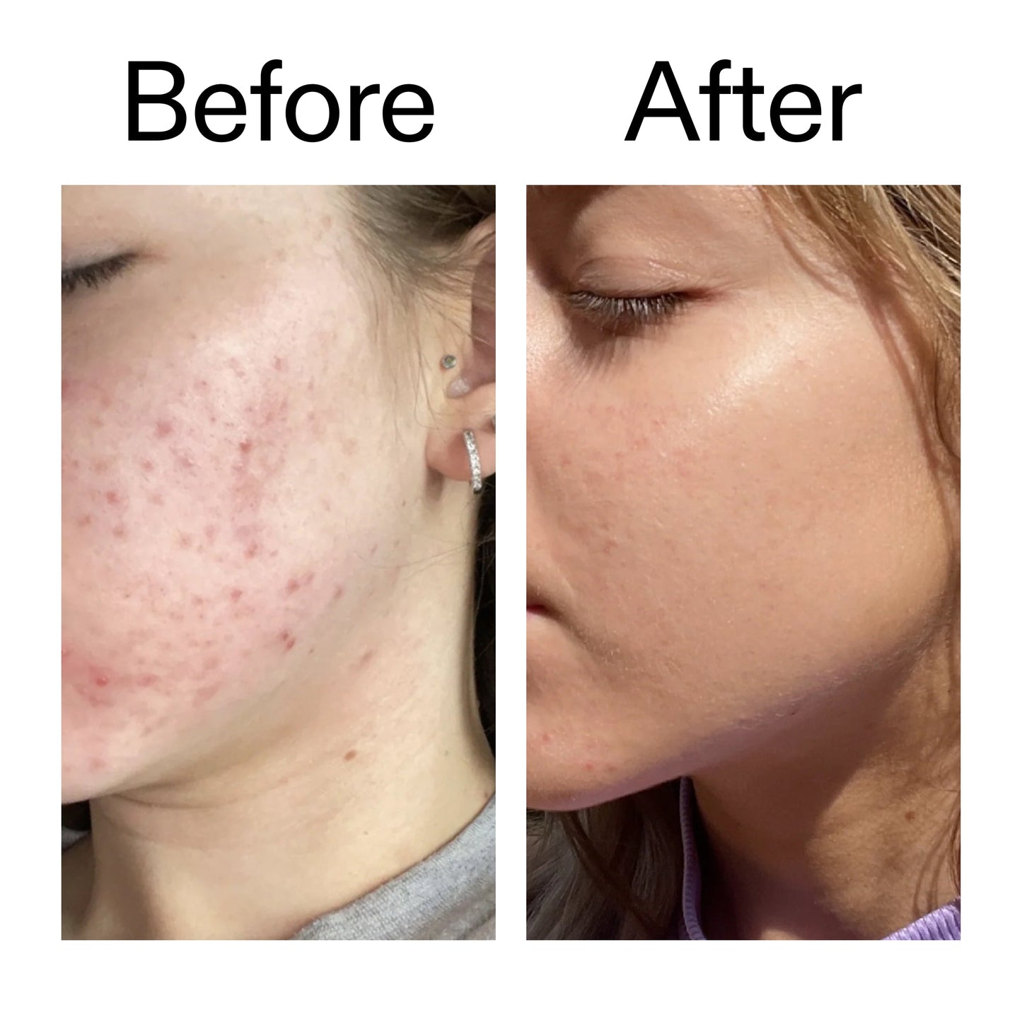 10-niacinamide-serum-i0 Niacinamide_Serum_Before_After_2000x2000_bde32455-9e7d-448e-b053-bef41504f0a9.jpg