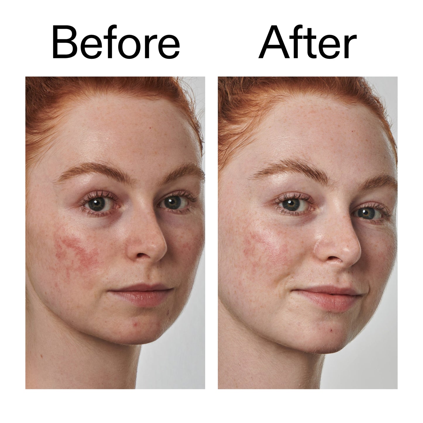10-azelaic-acid-serum-for-redness-relief-e6 Redness_Relief_Serum_Before_After_2000x2000_3334dc9a-cce9-4e00-8aec-7ad89ca051f2.jpg