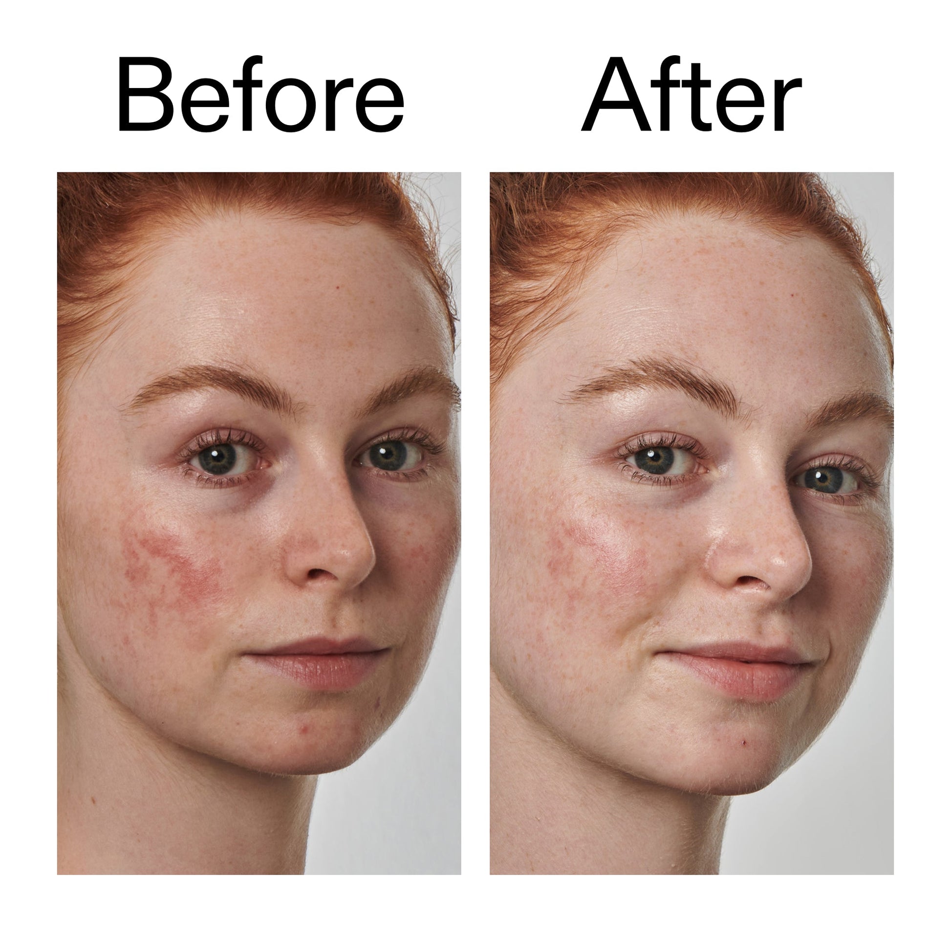 10-azelaic-acid-serum-for-redness-relief-e6 Redness_Relief_Serum_Before_After_2000x2000_3334dc9a-cce9-4e00-8aec-7ad89ca051f2.jpg