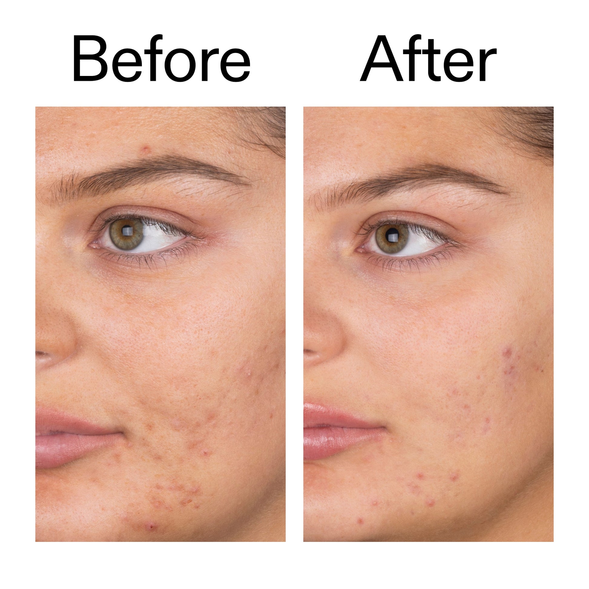 salicylic-acid-cleanser-150ml-i8 Salicylic_Acid_Cleanser_-_150ml_Before_After_2000x2000_e7230494-853f-4b07-82b1-27669104c995.jpg
