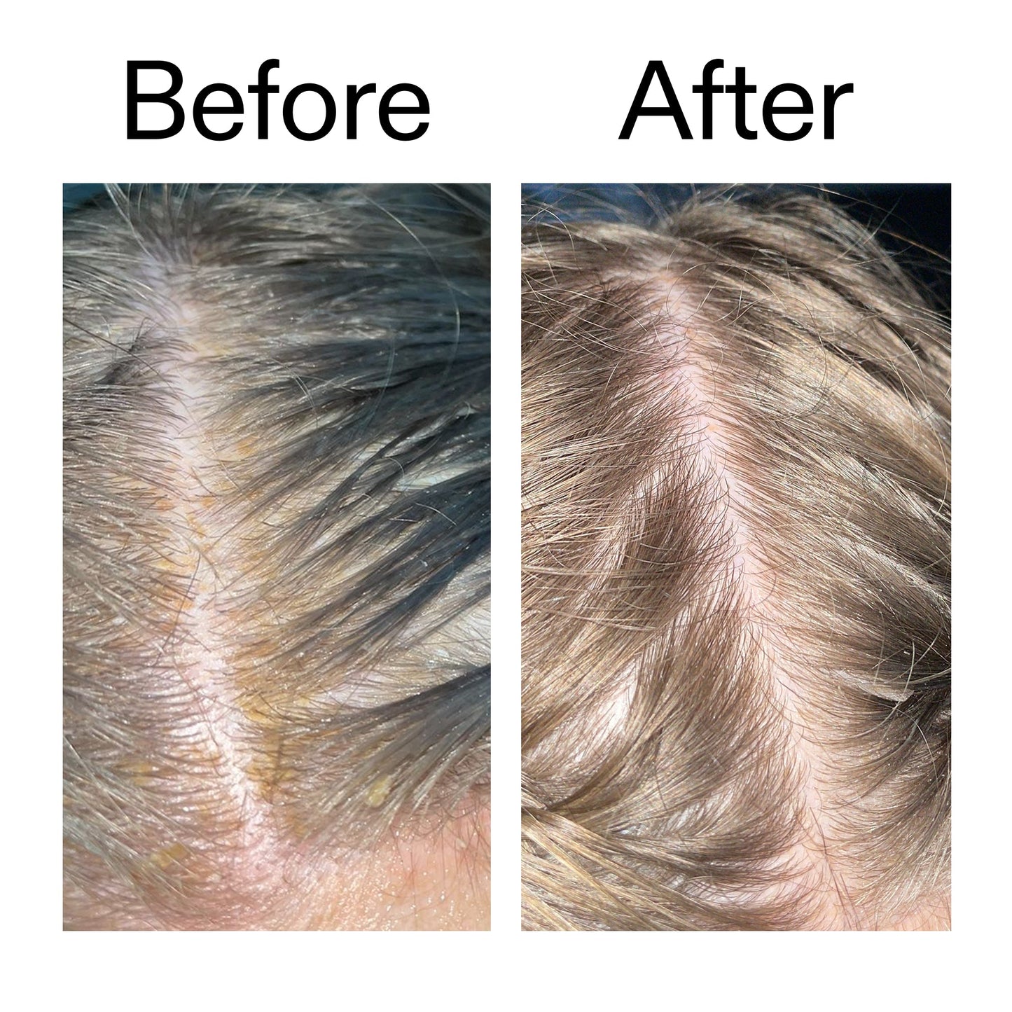 salicylic-acid-exfoliating-scalp-treatment-r4 Salicylic_Acid_Exfoliating_Scalp_Treatment_Before_After_2000x2000_e572a30f-057c-4a48-823b-1c09dc97f8d0.jpg