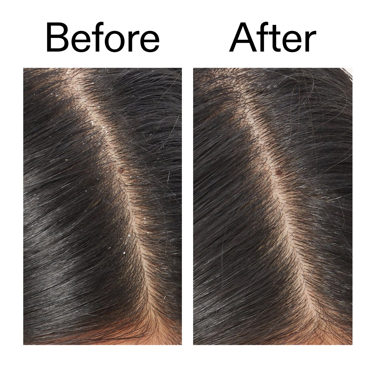 salicylic-acid-exfoliating-scalp-treatment-r4 Salicylic_Acid_Exfoliating_Scalp_Treatment_Before_After_V2_2000x2000_02bd61ad-42bf-490b-b3e3-7e04b2e8a673.jpg