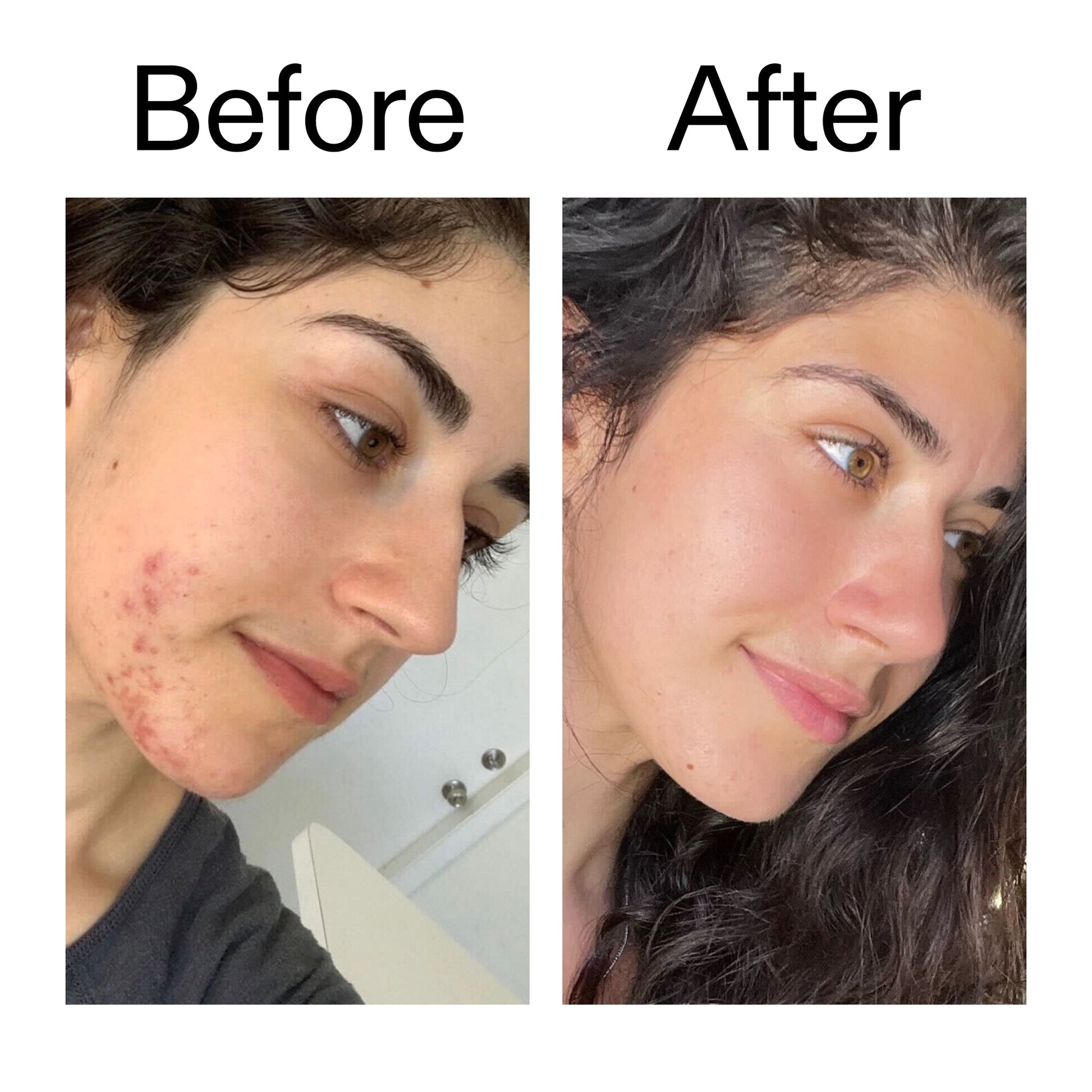 succinic-acid-acne-treatment-k3 Succinic_Acid_Treatment_Before_After_2000x2000_6a5f0054-2f58-4433-9314-0dc72c9bdd3b.jpg