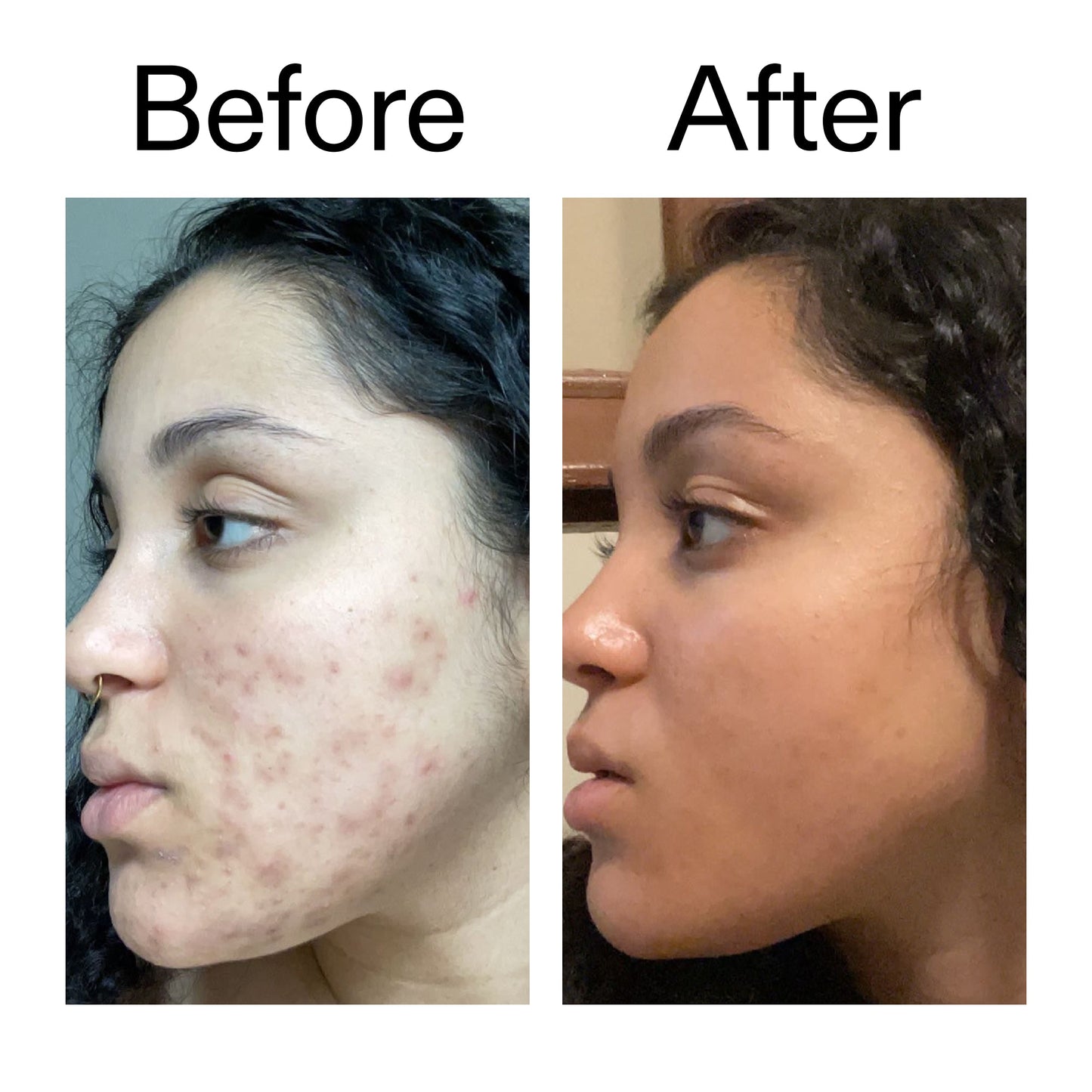 tranexamic-acid-serum-h9 Tranexamic_Acid_Serum_Before_After_2000x2000_98ebc8be-77b0-4843-8a22-90790ebe918b.jpg